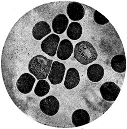 Malaria: tertian form